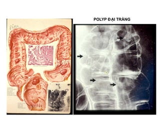 POLYP ĐẠI TRÀNG
 