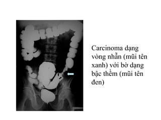 Carcinoma dạng
vòng nhẫn (mũi tên
xanh) với bờ dạng
bậc thềm (mũi tên
đen)
 