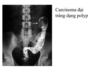 Carcinoma đại
tràng dạng polyp
 
