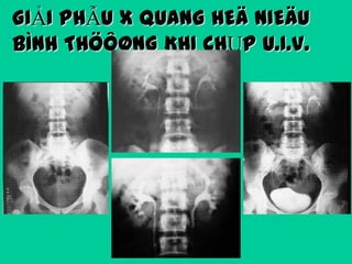 GIẢI PHẪU X QUANG HEÄ NIEÄU
BÌNH THÖÔØNG KHI CHỤP U.I.V.

 