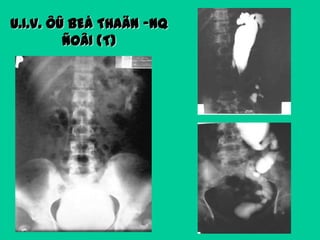 U.I.V. ÔÛ BEÅ THAÄN ‟NQ
ÑOÂI (T)

 