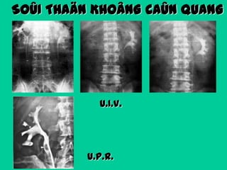 SOÛI THAÄN KHOÂNG CAÛN QUANG

U.I.V.

U.P.R.

 