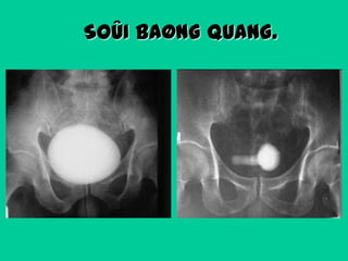 SOÛI BAØNG QUANG.

 