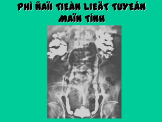 PHÌ ÑAÏI TIEÀN LIEÄT TUYEÁN
MAÏN TÍNH

 