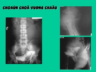 CHOAÙN CHOÃ VUØNG CHAÄU

 