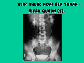 HEÏP KHUÙC NOÁI BEÅ THAÄN NIEÄU QUAÛN (T).

 