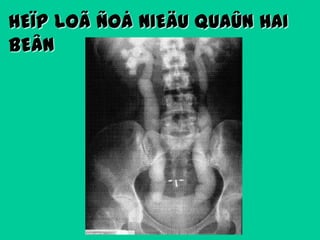 HEÏP LOÃ ÑOÅ NIEÄU QUAÛN HAI
BEÂN

 