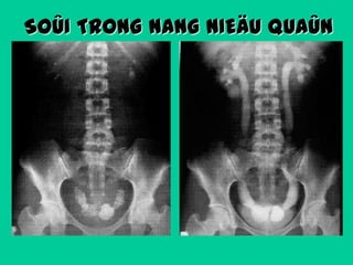 SOÛI TRONG NANG NIEÄU QUAÛN

 