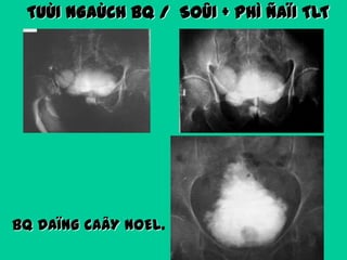 TUÙI NGAÙCH BQ / SOÛI + PHÌ ÑAÏI TLT

BQ DAÏNG CAÂY NOEL.

 