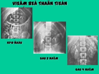 VIEÂM BEÅ THAÄN TIEÁN
TRIEÅN

KYØ ÑAÀU

SAU 2 NAÊM
SAU 4 NAÊM

 