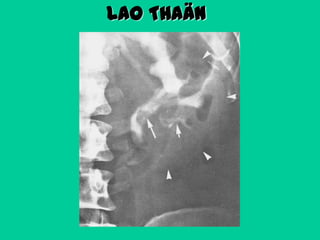 LAO THAÄN

 