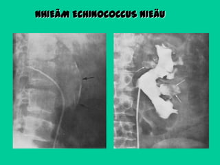 NHIEÃM ECHINOCOCCUS NIEÄU

 