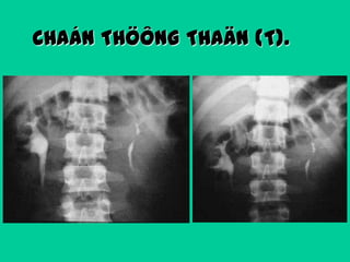 CHAÁN THÖÔNG THAÄN (T).

 