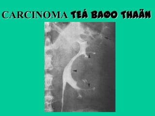 CARCINOMA TEÁ BAØO THAÄN

 