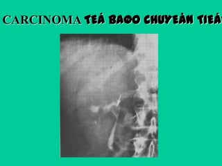 CARCINOMA TEÁ BAØO CHUYEÅN TIEÁP

 