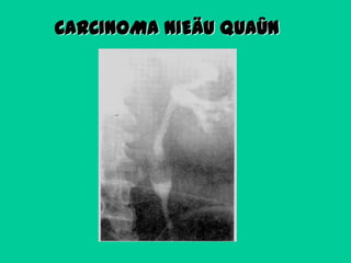 CARCINOMA NIEÄU QUAÛN

 