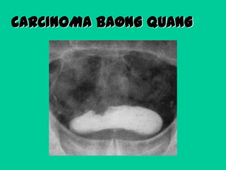 CARCINOMA BAØNG QUANG

 