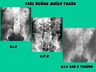 TAÉC ÑOÄNG MAÏCH THAÄN

U.I.V

U.P.R
U.I.V SAU 2 THAÙNG

 