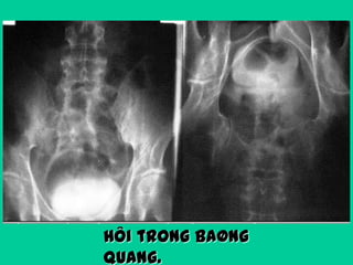 Hôi trong baøng
quang.

 