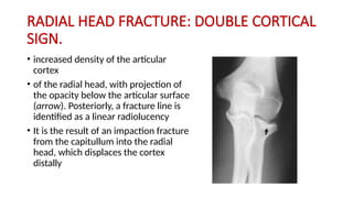 Comprehensive Guide to Reading Elbow X-Rays for Fracture Detection and ...