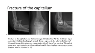 Double Capitulum Comprehensive Guide to Reading Elbow X-Rays for Fracture Detection and ...
