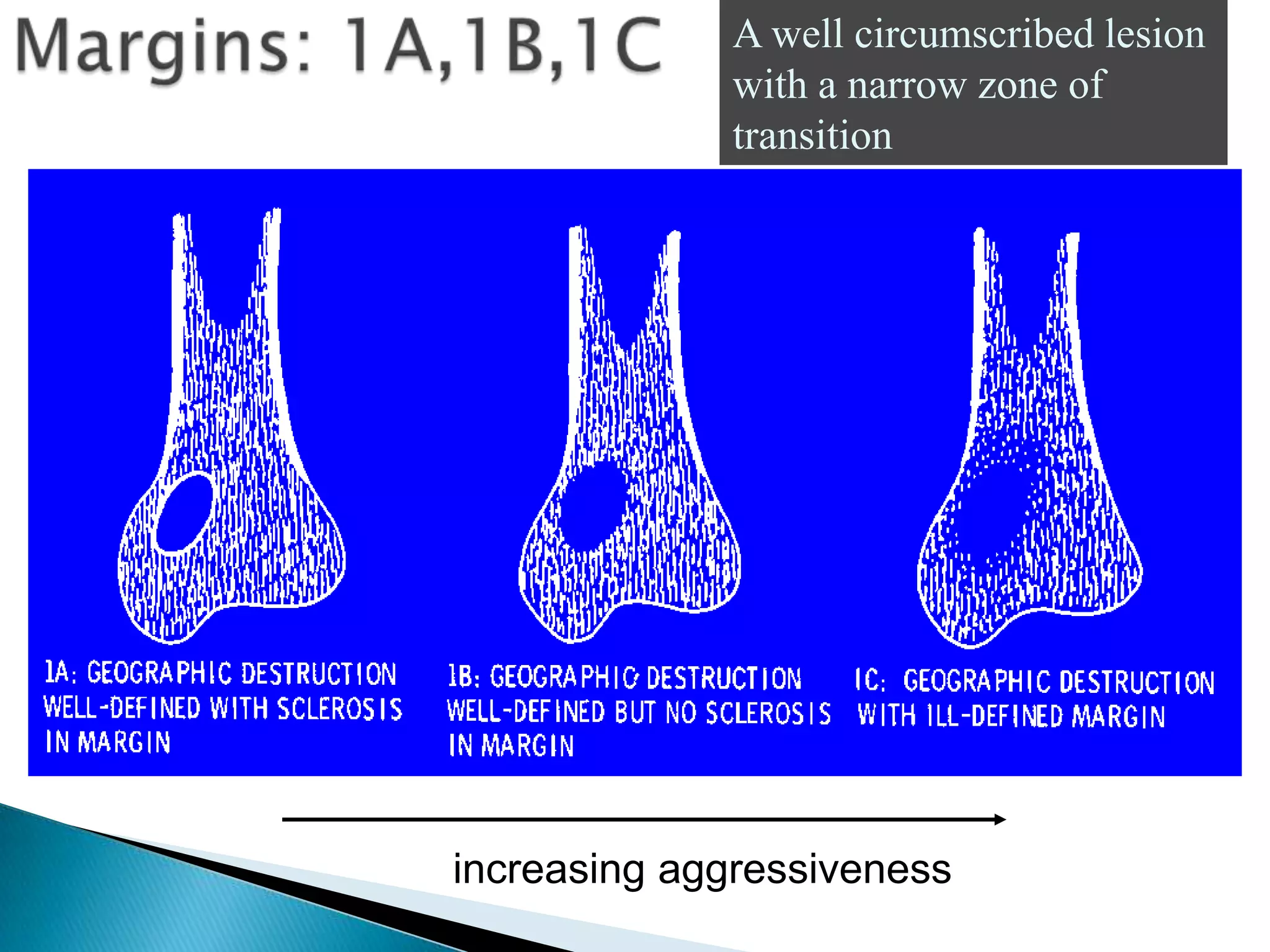 A well circumscribed lesion
              with a narrow zone of
              transition




increasing aggressiveness
 