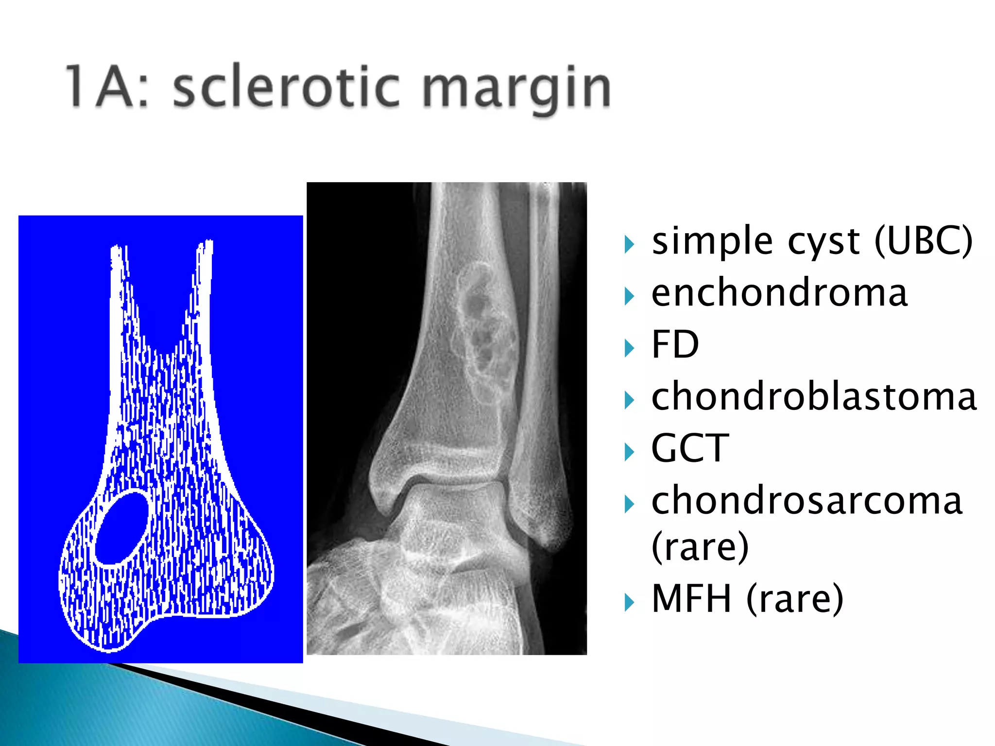    simple cyst (UBC)
   enchondroma
   FD
   chondroblastoma
   GCT
   chondrosarcoma
    (rare)
   MFH (rare)
 