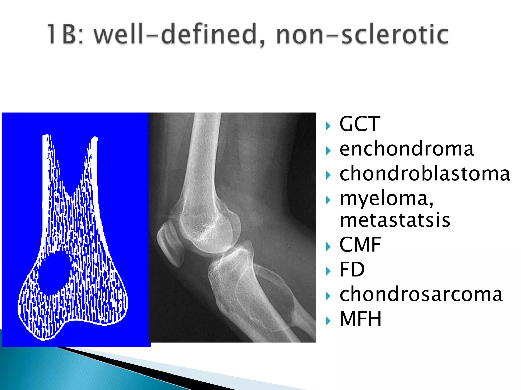   GCT
   enchondroma
   chondroblastoma
   myeloma,
    metastatsis
   CMF
   FD
   chondrosarcoma
   MFH
 