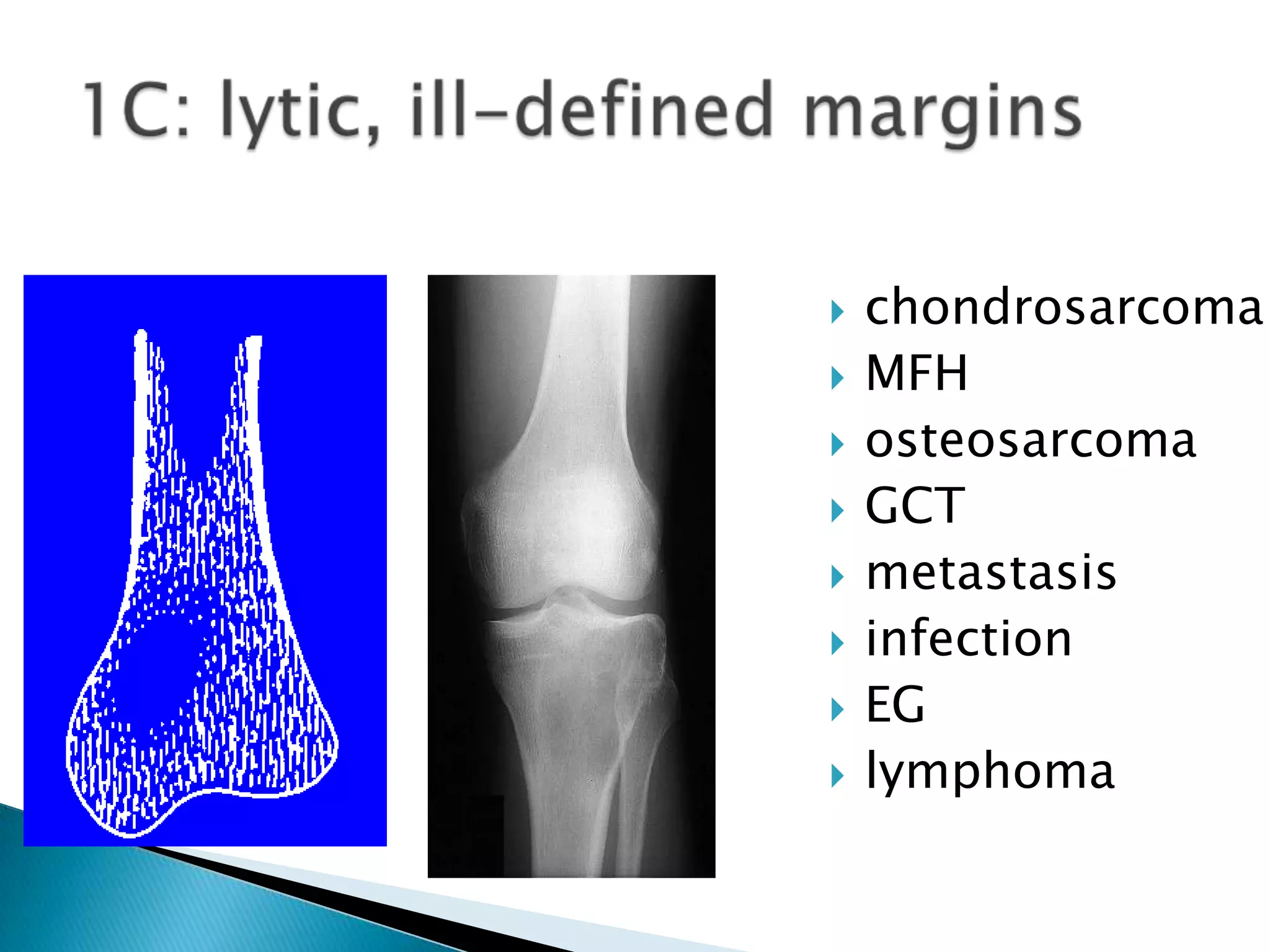    chondrosarcoma
   MFH
   osteosarcoma
   GCT
   metastasis
   infection
   EG
   lymphoma
 