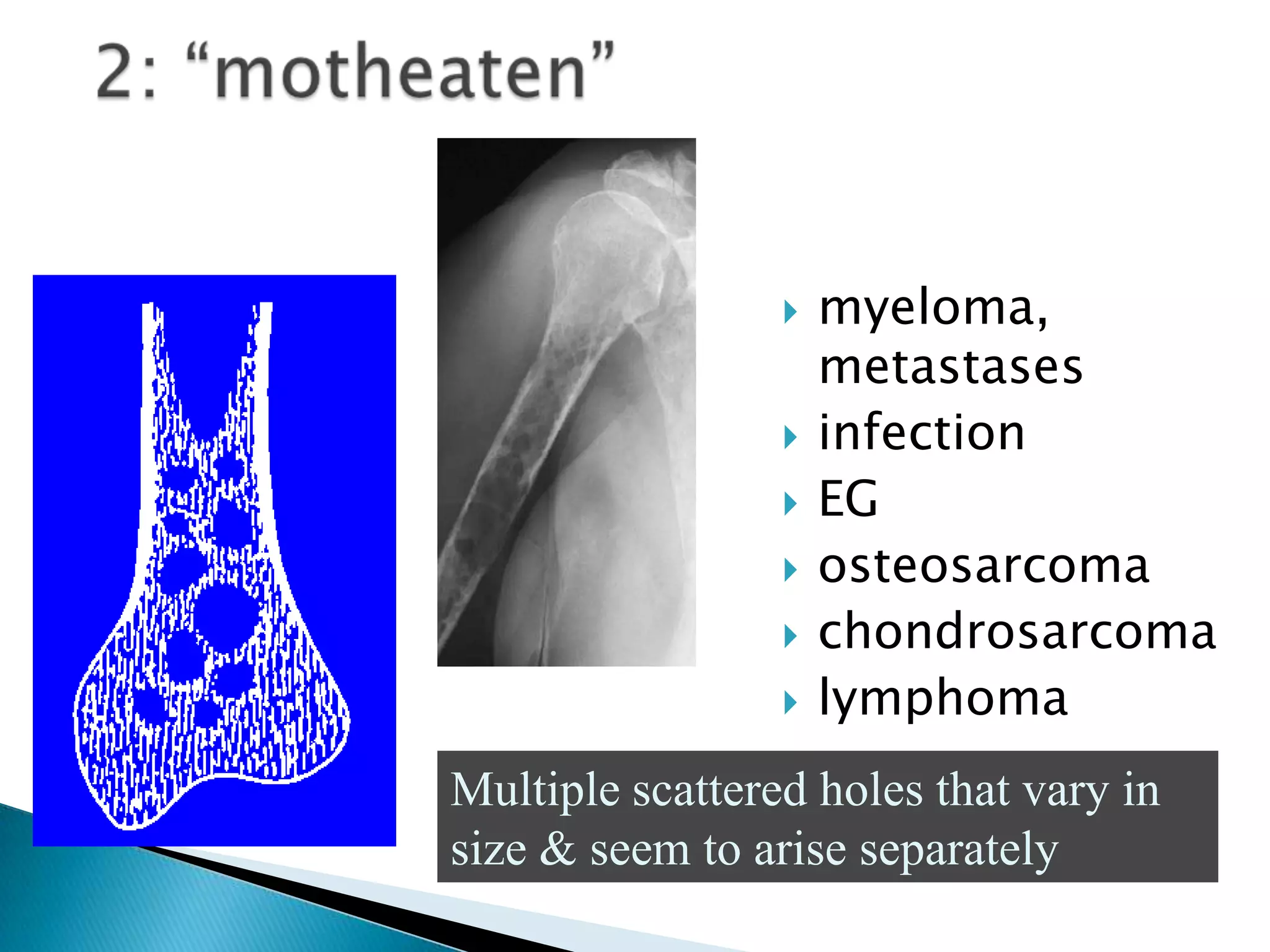   myeloma,
                     metastases
                    infection
                    EG
                    osteosarcoma
                    chondrosarcoma
                    lymphoma
Multiple scattered holes that vary in
size & seem to arise separately
 