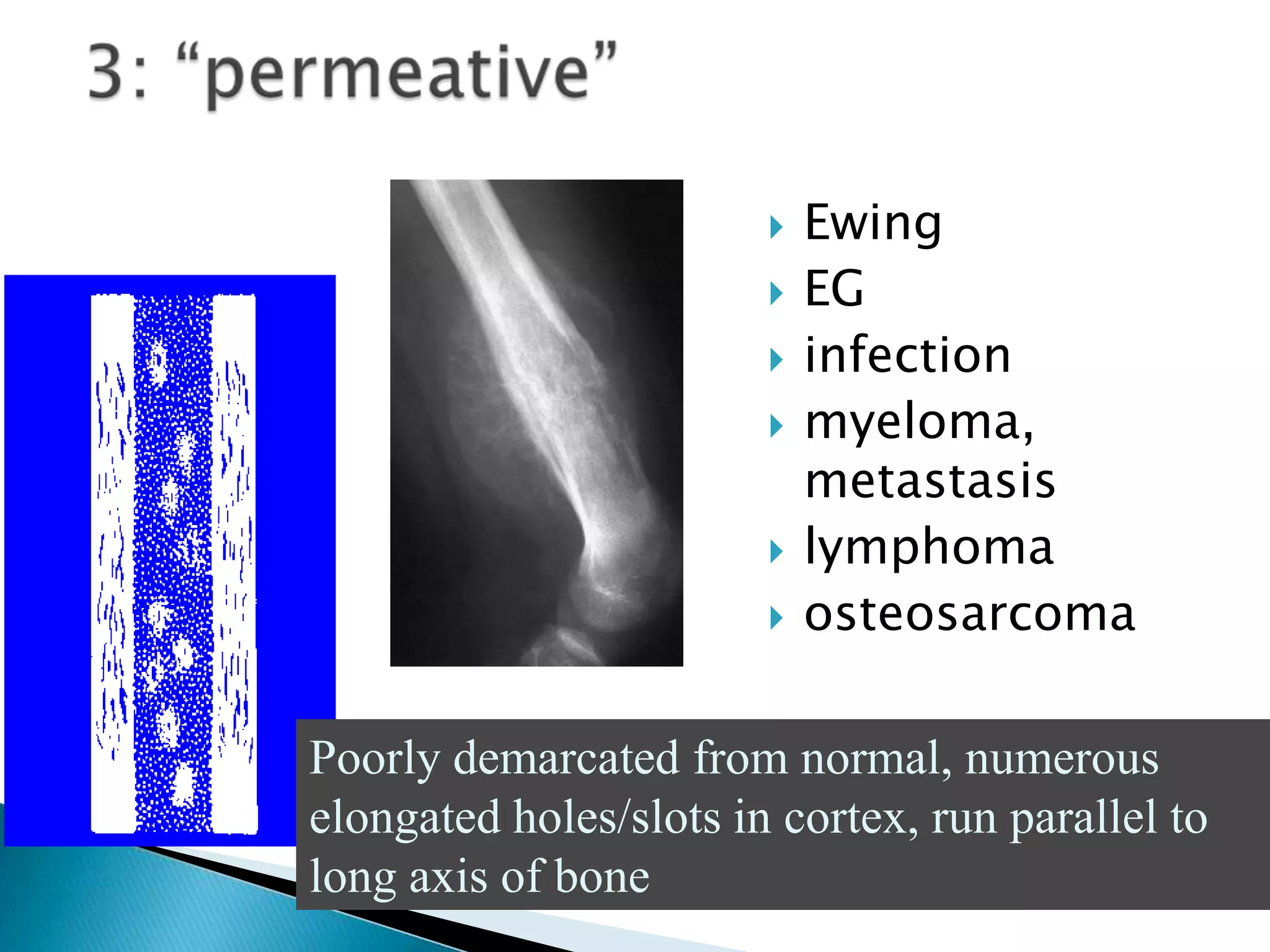    Ewing
                           EG
                           infection
                           myeloma,
                            metastasis
                           lymphoma
                           osteosarcoma

Poorly demarcated from normal, numerous
elongated holes/slots in cortex, run parallel to
long axis of bone
 