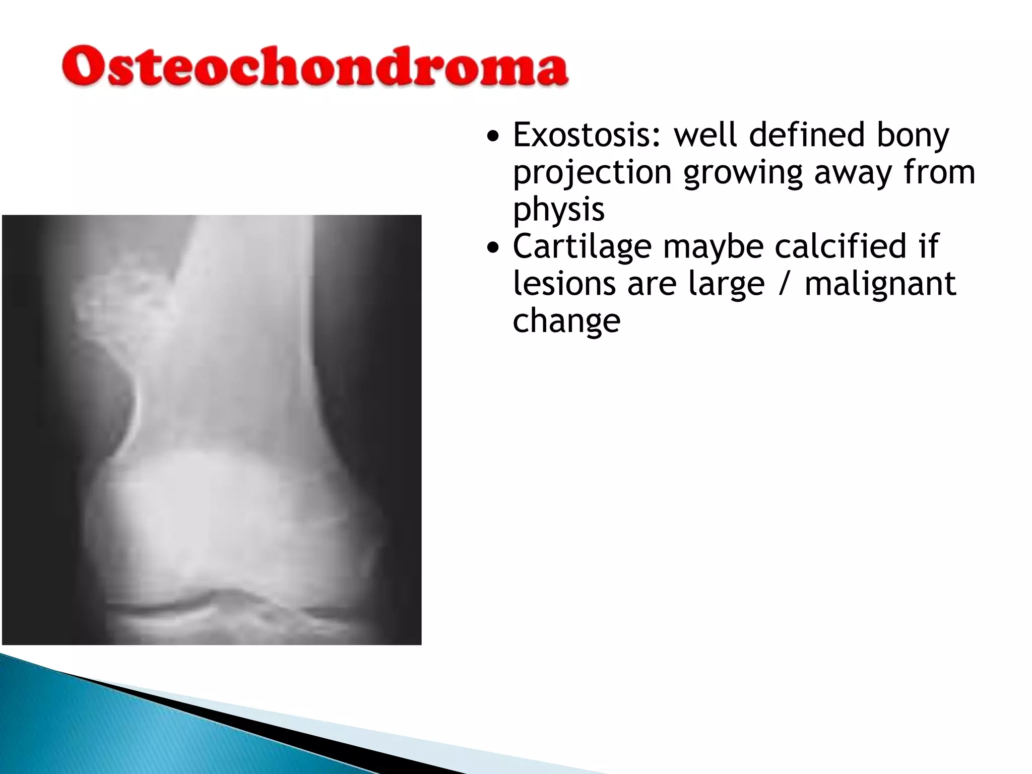  Exostosis: well defined bony
  projection growing away from
  physis
 Cartilage maybe calcified if
  lesions are large / malignant
  change
 