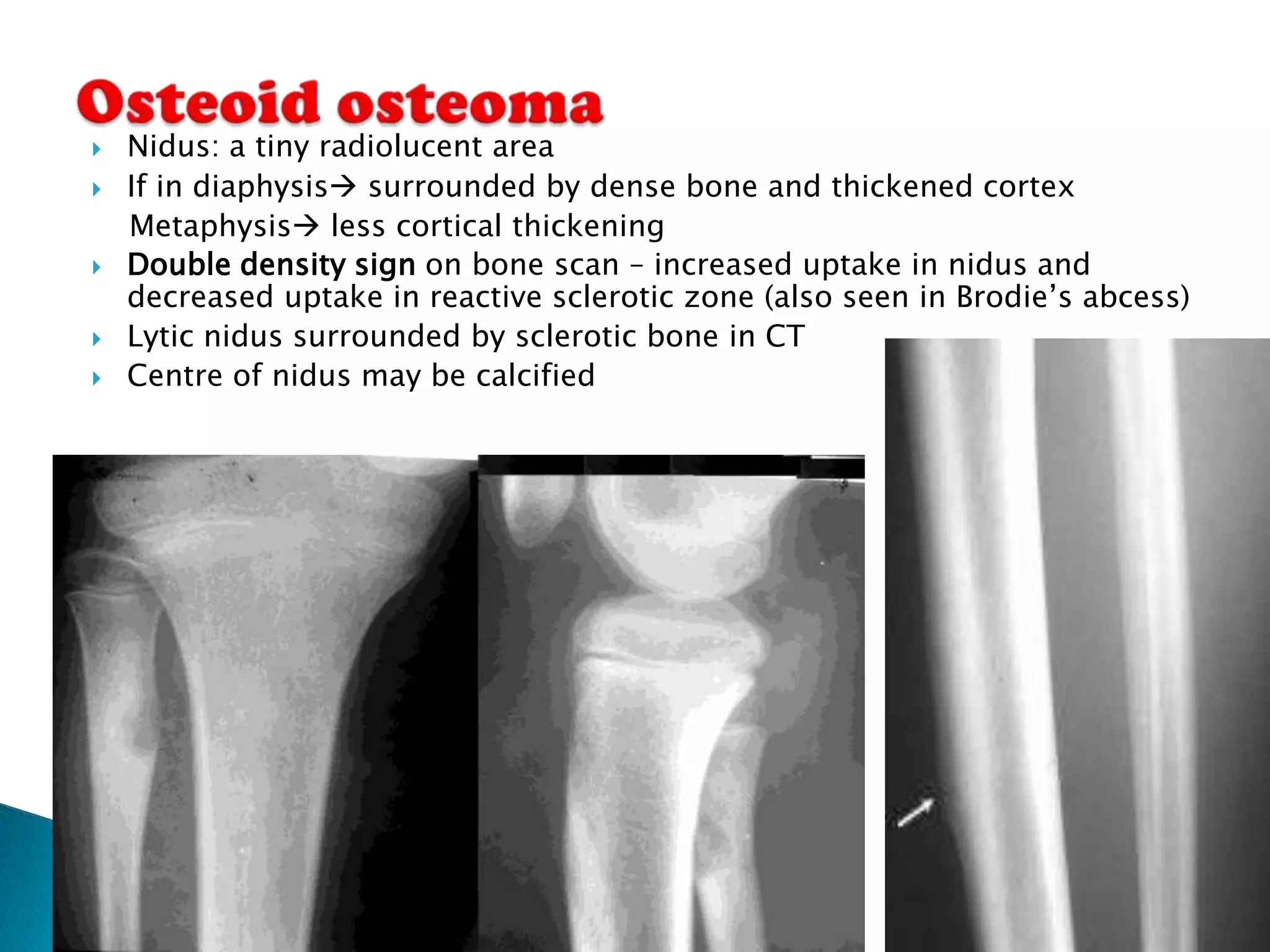    Nidus: a tiny radiolucent area
   If in diaphysis surrounded by dense bone and thickened cortex
    Metaphysis less cortical thickening
   Double density sign on bone scan – increased uptake in nidus and
    decreased uptake in reactive sclerotic zone (also seen in Brodie’s abcess)
   Lytic nidus surrounded by sclerotic bone in CT
   Centre of nidus may be calcified
 