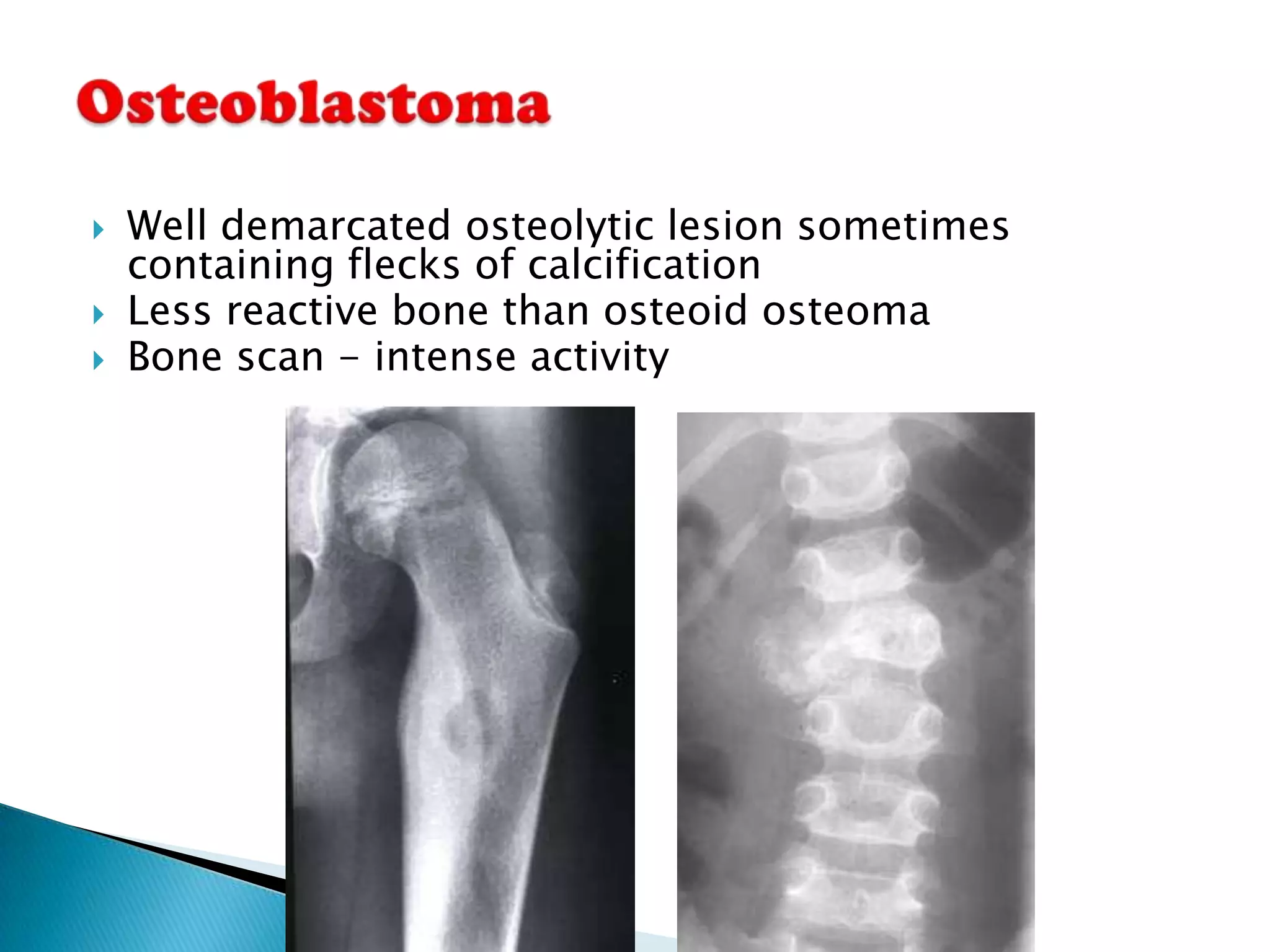    Well demarcated osteolytic lesion sometimes
    containing flecks of calcification
   Less reactive bone than osteoid osteoma
   Bone scan - intense activity
 