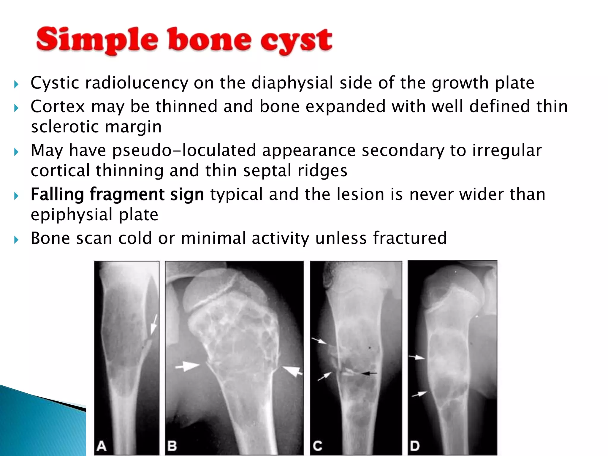    Cystic radiolucency on the diaphysial side of the growth plate
   Cortex may be thinned and bone expanded with well defined thin
    sclerotic margin
   May have pseudo-loculated appearance secondary to irregular
    cortical thinning and thin septal ridges
   Falling fragment sign typical and the lesion is never wider than
    epiphysial plate
   Bone scan cold or minimal activity unless fractured
 