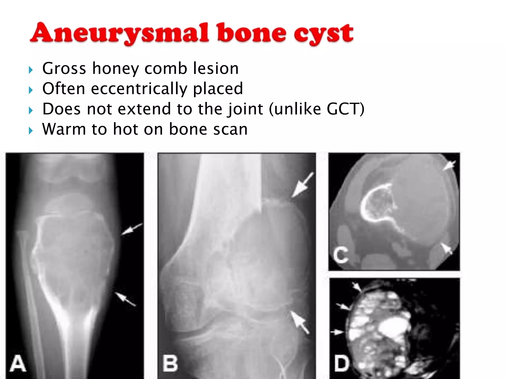    Gross honey comb lesion
   Often eccentrically placed
   Does not extend to the joint (unlike GCT)
   Warm to hot on bone scan
 