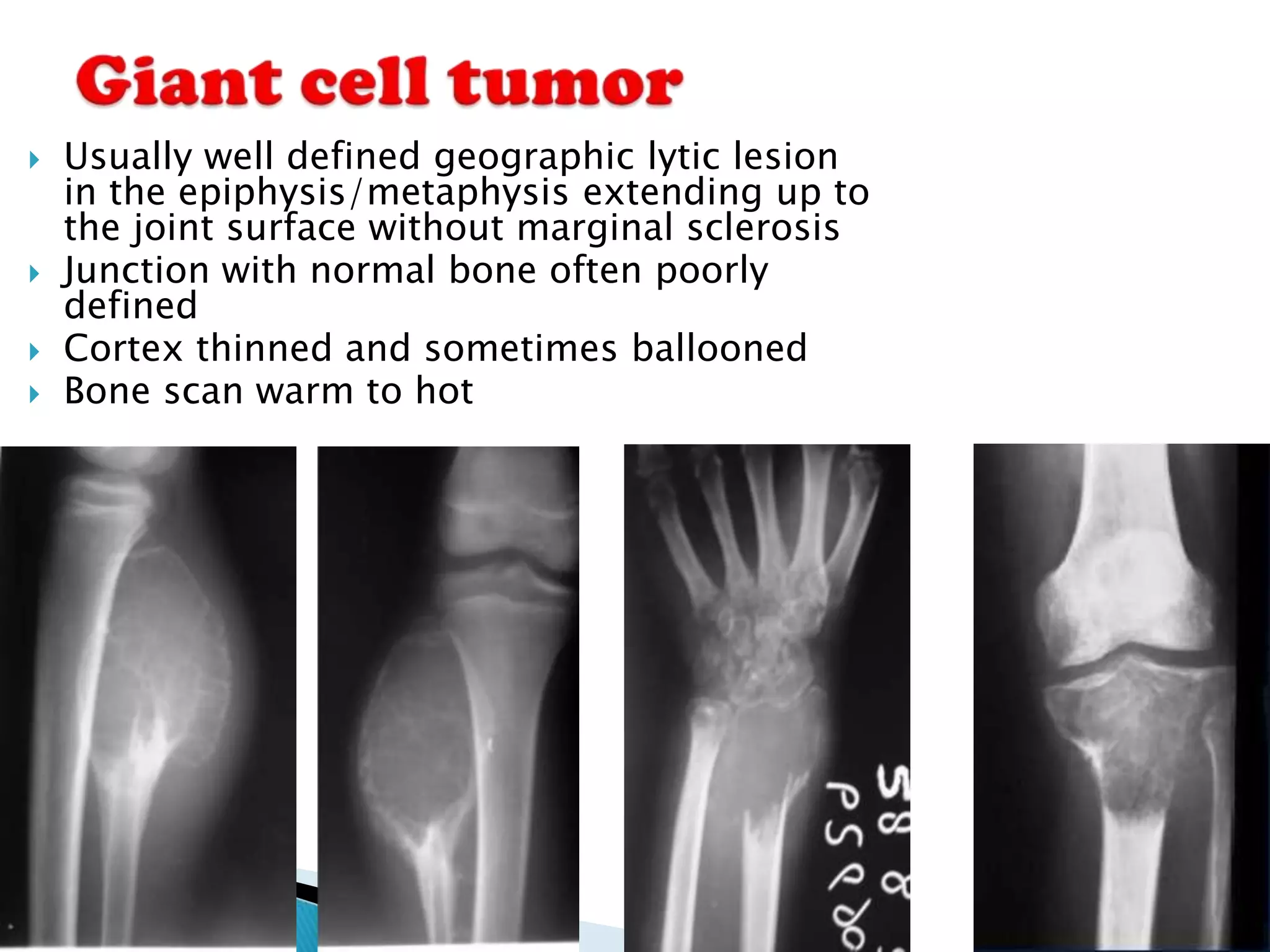    Usually well defined geographic lytic lesion
    in the epiphysis/metaphysis extending up to
    the joint surface without marginal sclerosis
   Junction with normal bone often poorly
    defined
   Cortex thinned and sometimes ballooned
   Bone scan warm to hot
 