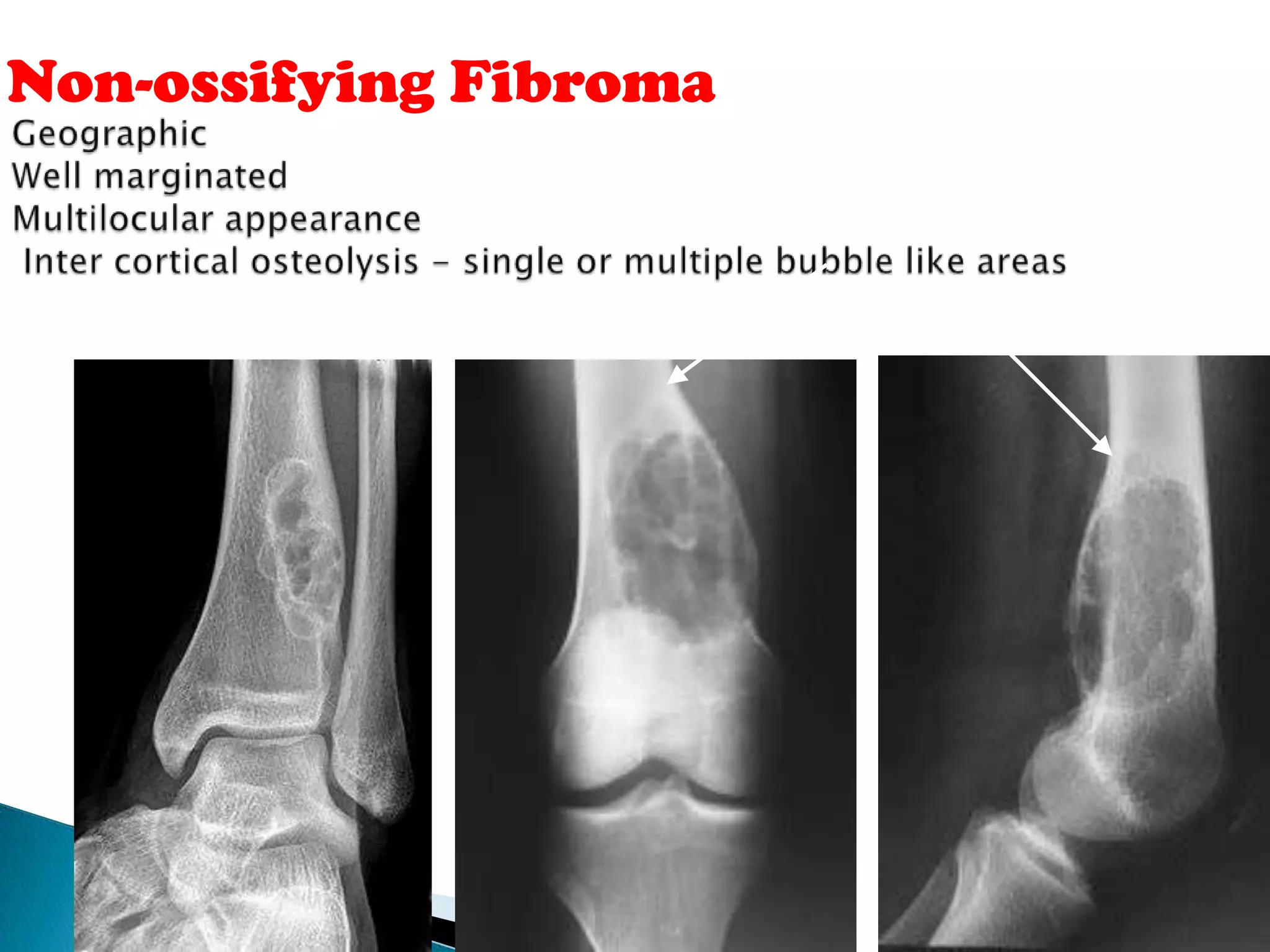 Non-ossifying Fibroma
 