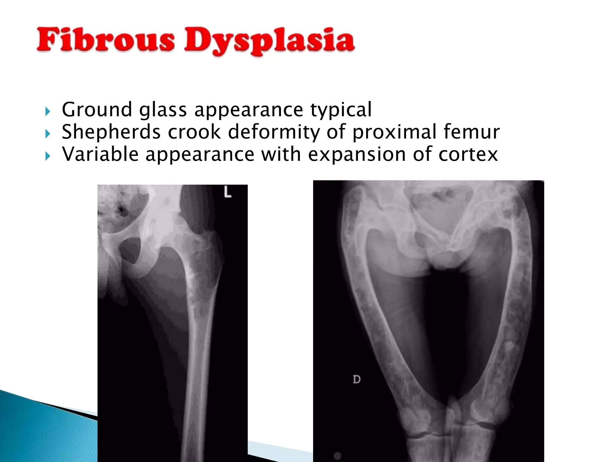    Ground glass appearance typical
   Shepherds crook deformity of proximal femur
   Variable appearance with expansion of cortex
 