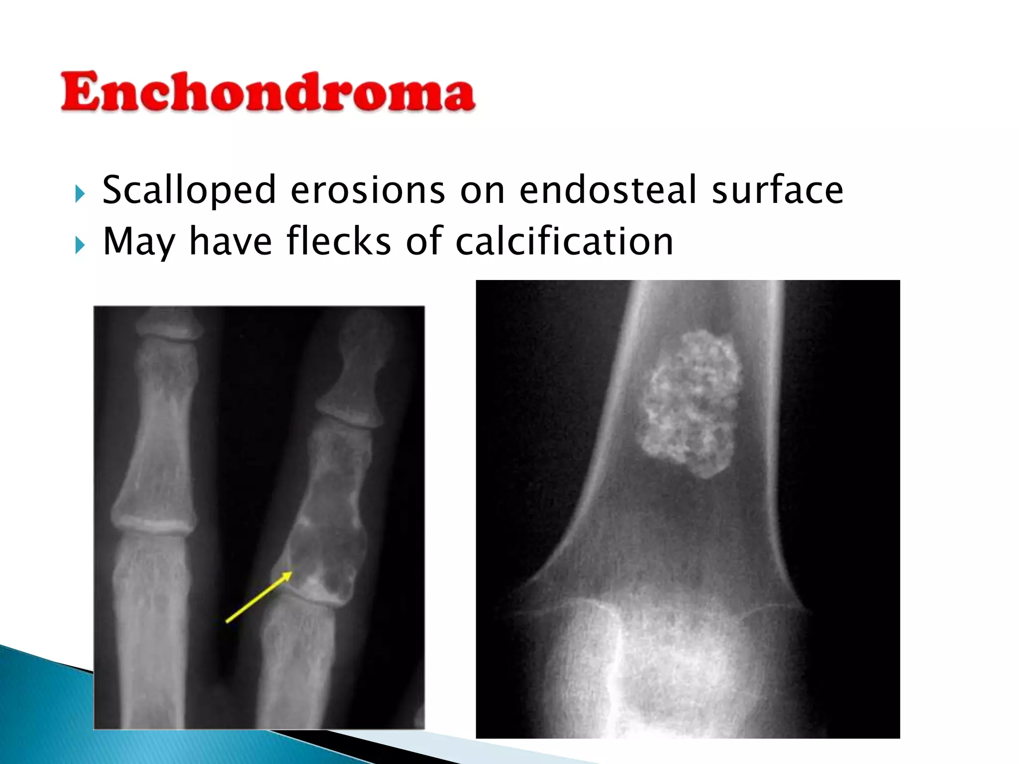    Scalloped erosions on endosteal surface
   May have flecks of calcification
 