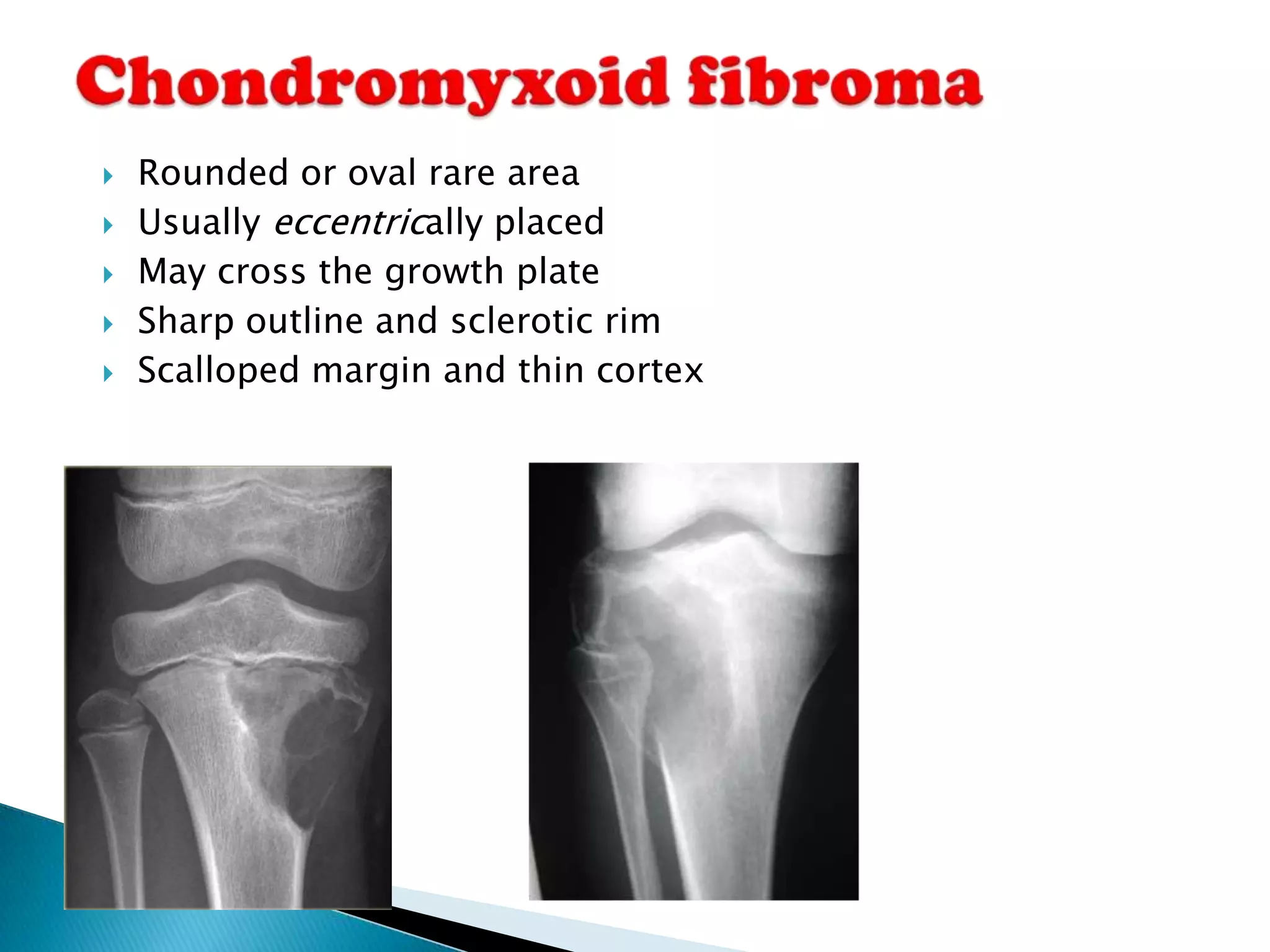    Rounded or oval rare area
   Usually eccentrically placed
   May cross the growth plate
   Sharp outline and sclerotic rim
   Scalloped margin and thin cortex
 