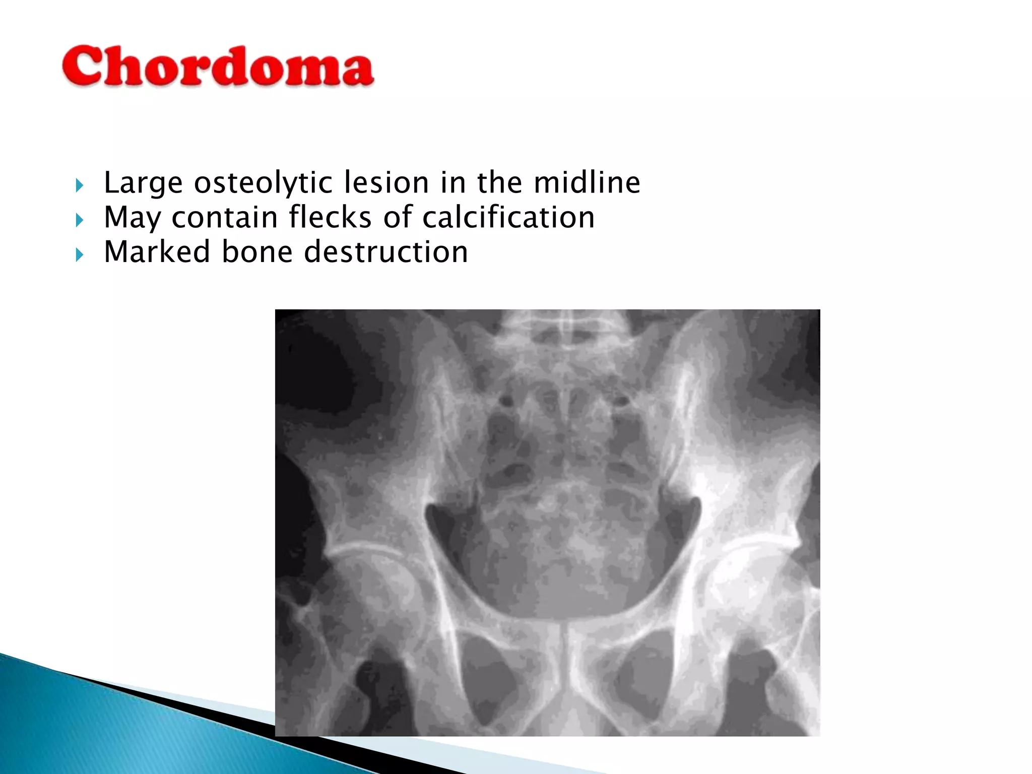    Large osteolytic lesion in the midline
   May contain flecks of calcification
   Marked bone destruction
 
