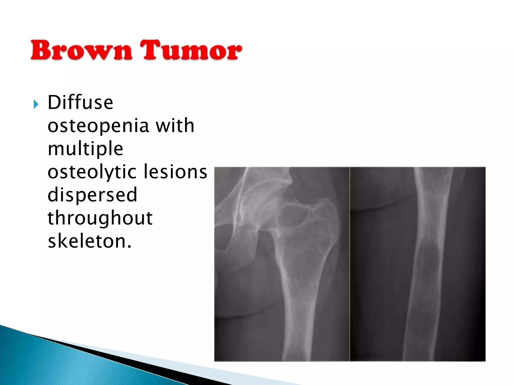    Diffuse
    osteopenia with
    multiple
    osteolytic lesions
    dispersed
    throughout
    skeleton.
 