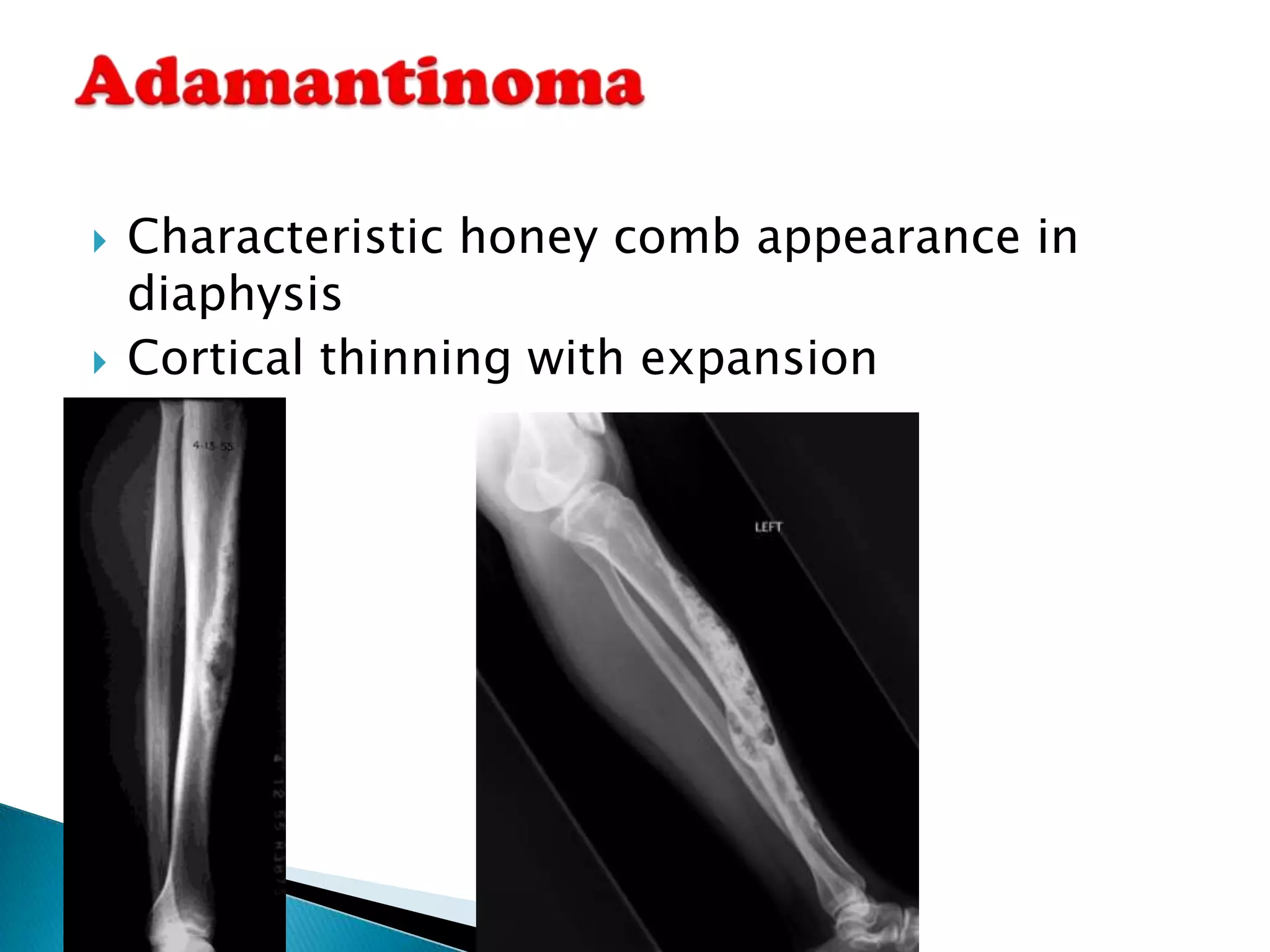    Characteristic honey comb appearance in
    diaphysis
   Cortical thinning with expansion
 
