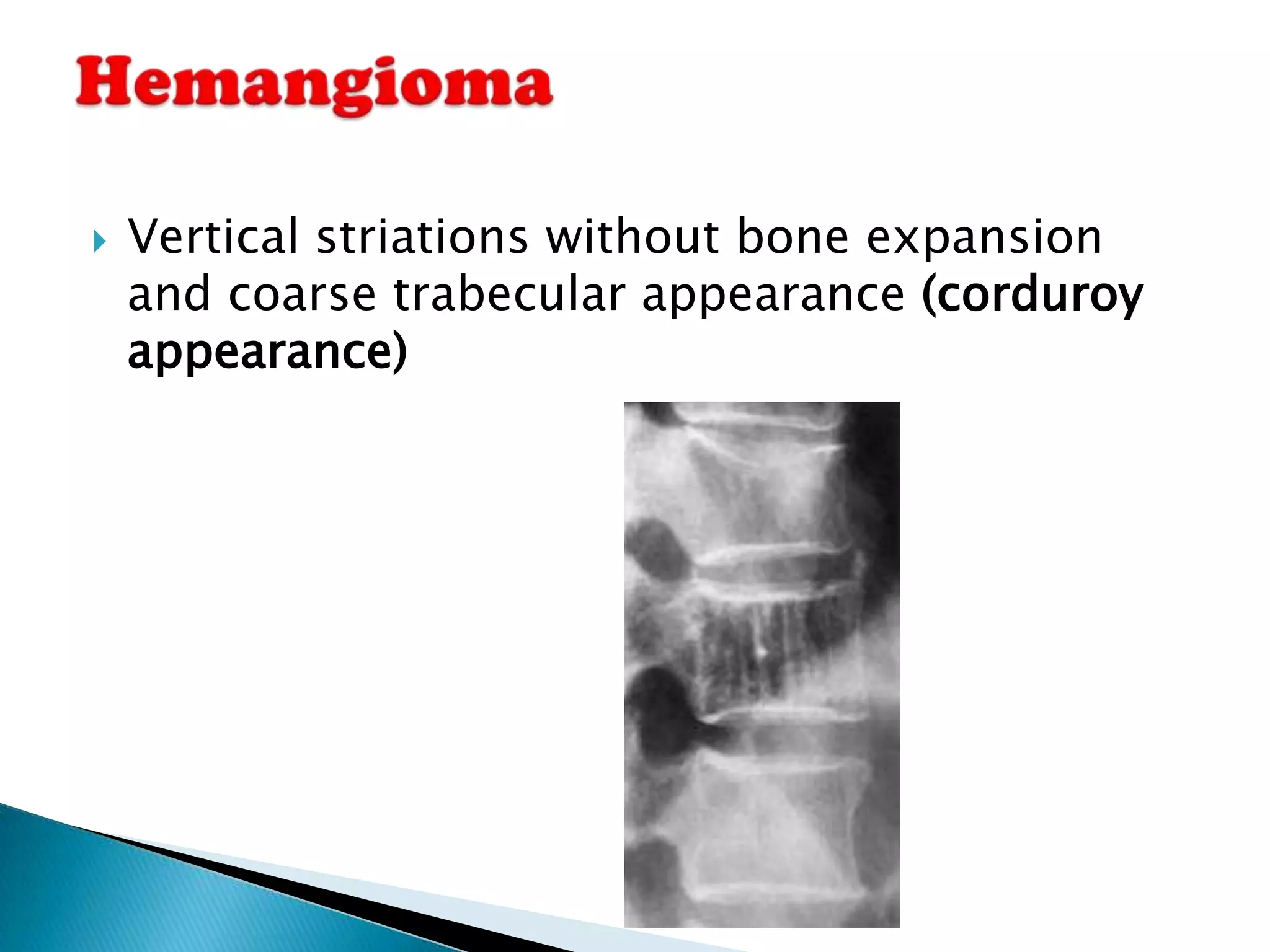    Vertical striations without bone expansion
    and coarse trabecular appearance (corduroy
    appearance)
 