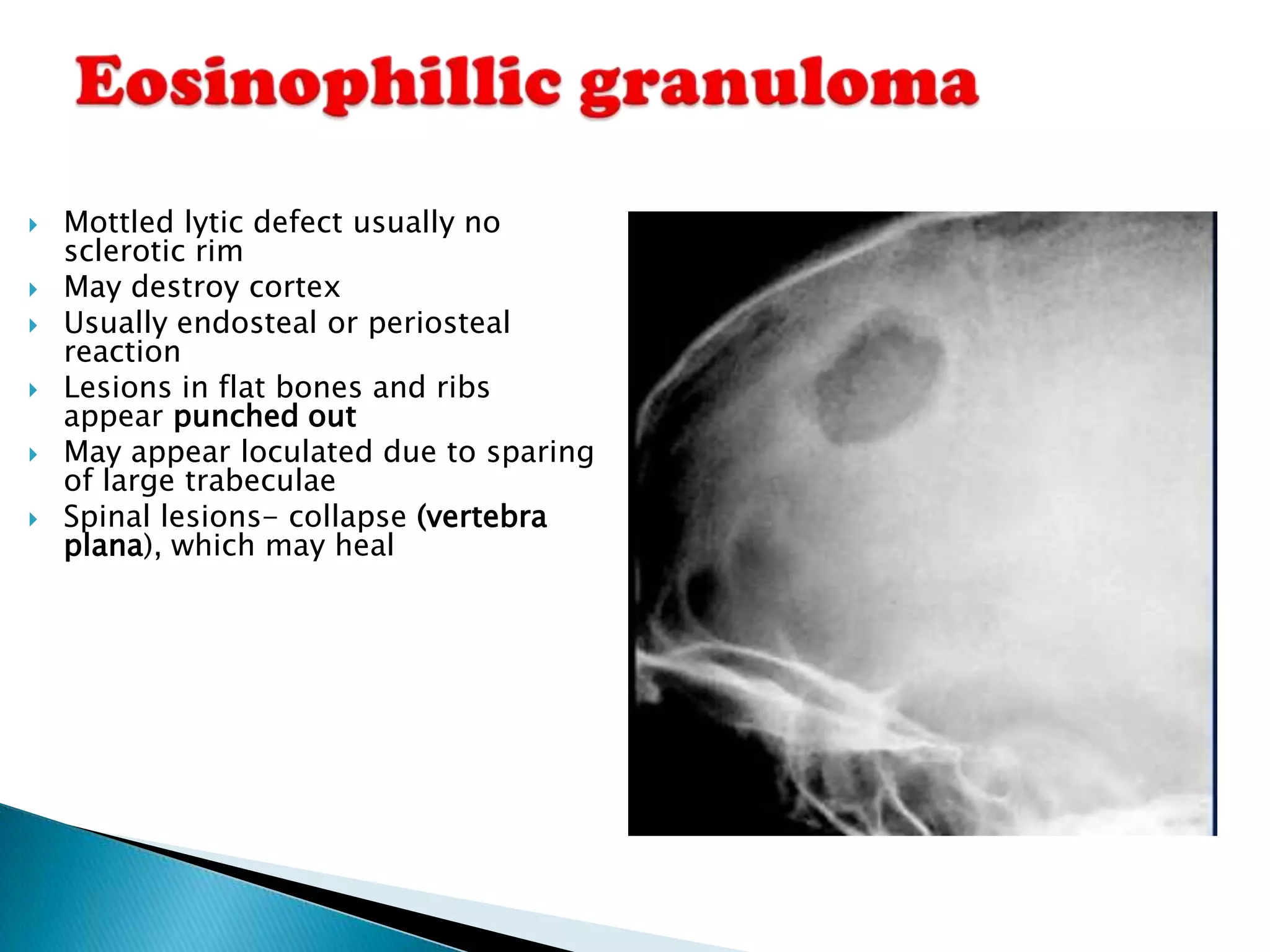    Mottled lytic defect usually no
    sclerotic rim
   May destroy cortex
   Usually endosteal or periosteal
    reaction
   Lesions in flat bones and ribs
    appear punched out
   May appear loculated due to sparing
    of large trabeculae
   Spinal lesions- collapse (vertebra
    plana), which may heal
 