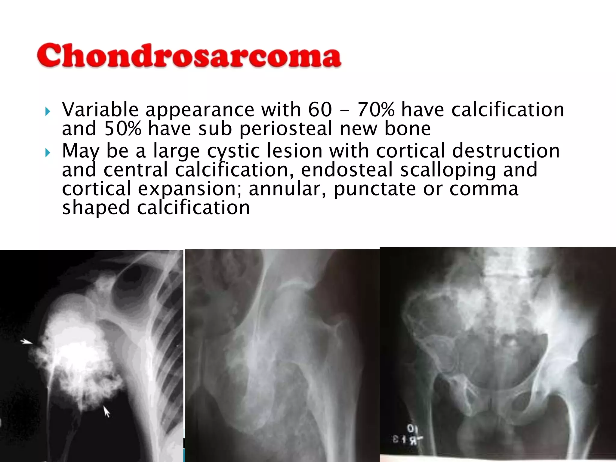    Variable appearance with 60 - 70% have calcification
    and 50% have sub periosteal new bone
   May be a large cystic lesion with cortical destruction
    and central calcification, endosteal scalloping and
    cortical expansion; annular, punctate or comma
    shaped calcification
 
