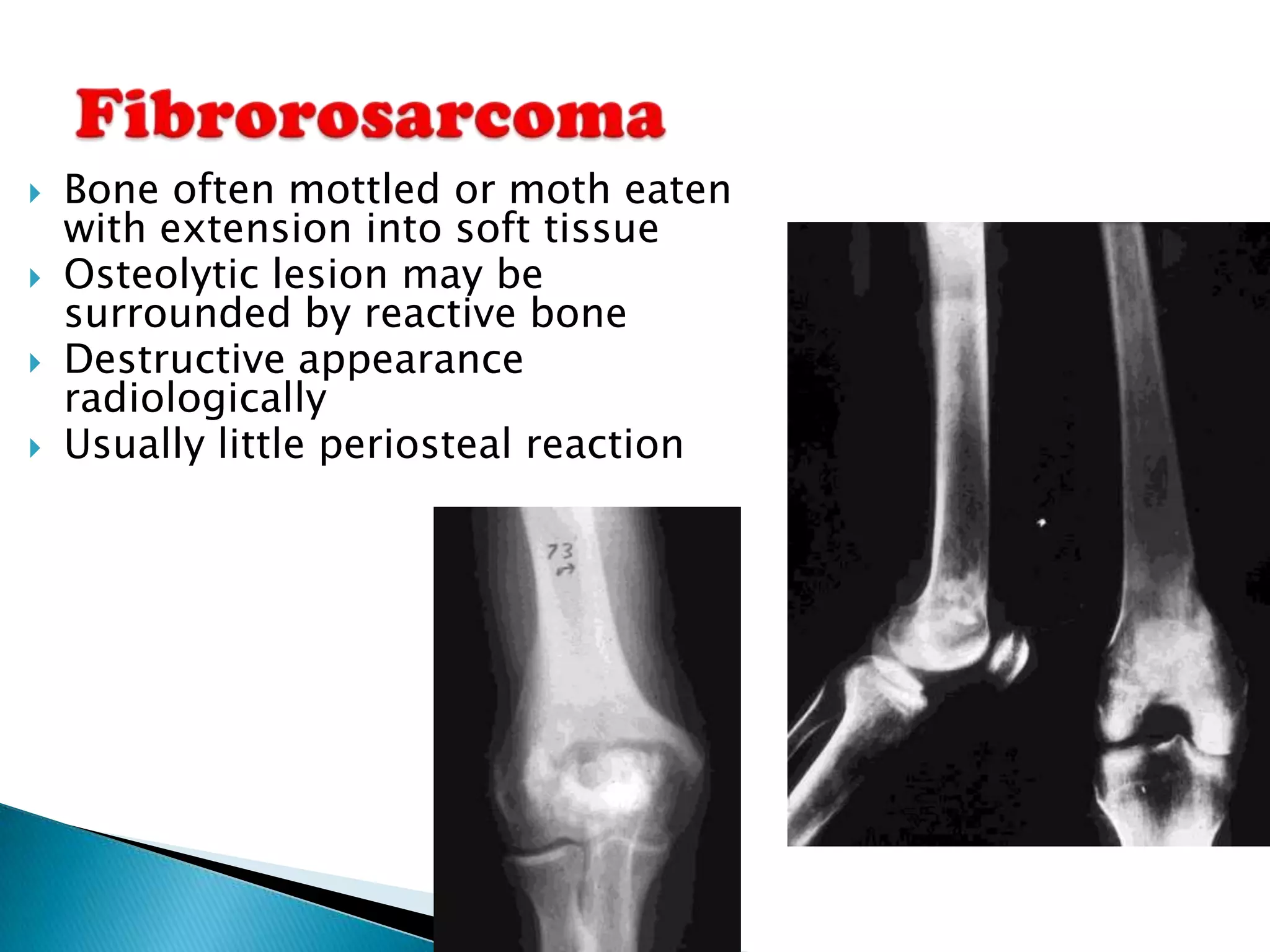    Bone often mottled or moth eaten
    with extension into soft tissue
   Osteolytic lesion may be
    surrounded by reactive bone
   Destructive appearance
    radiologically
   Usually little periosteal reaction
 