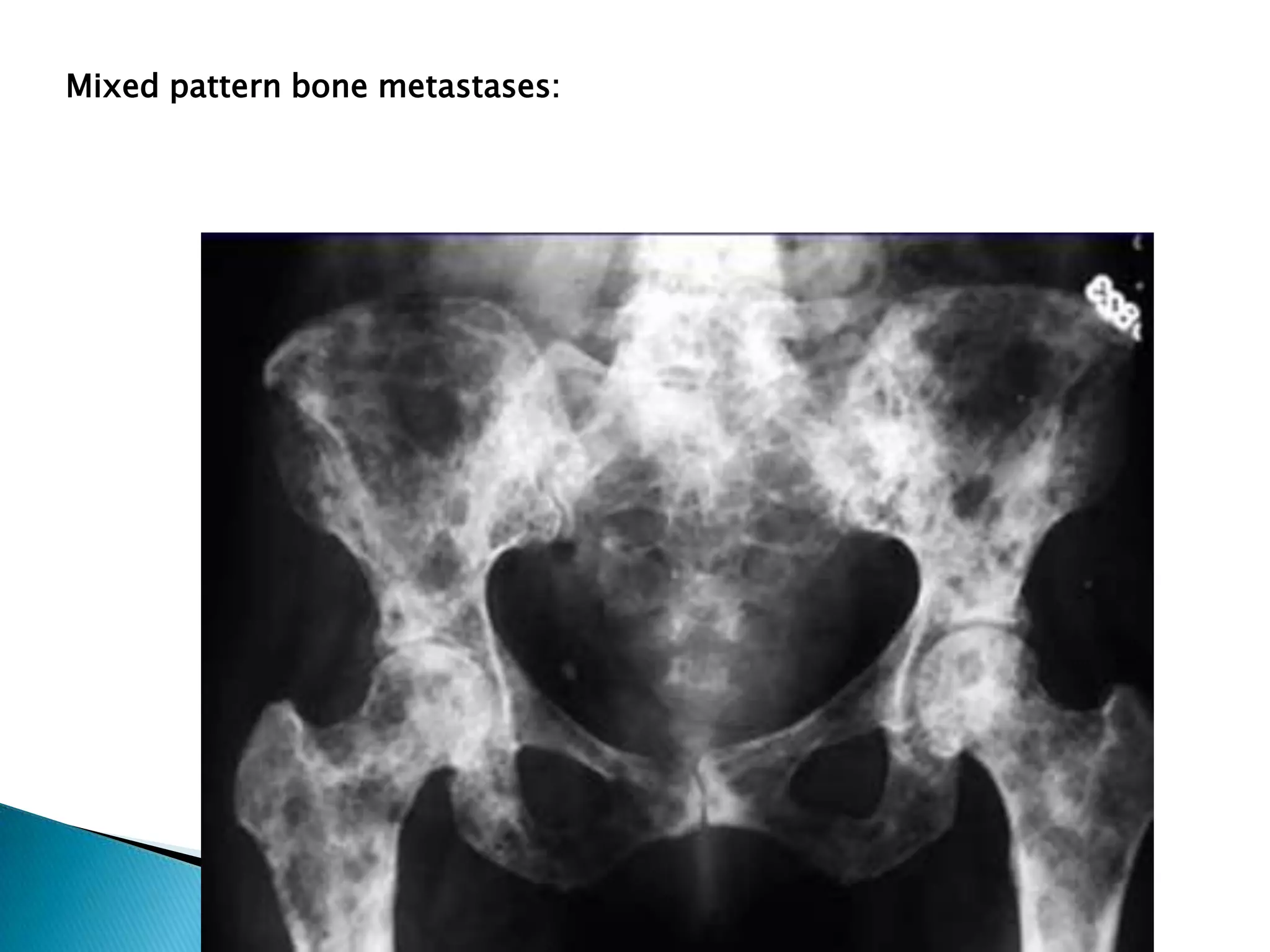 Mixed pattern bone metastases:
 