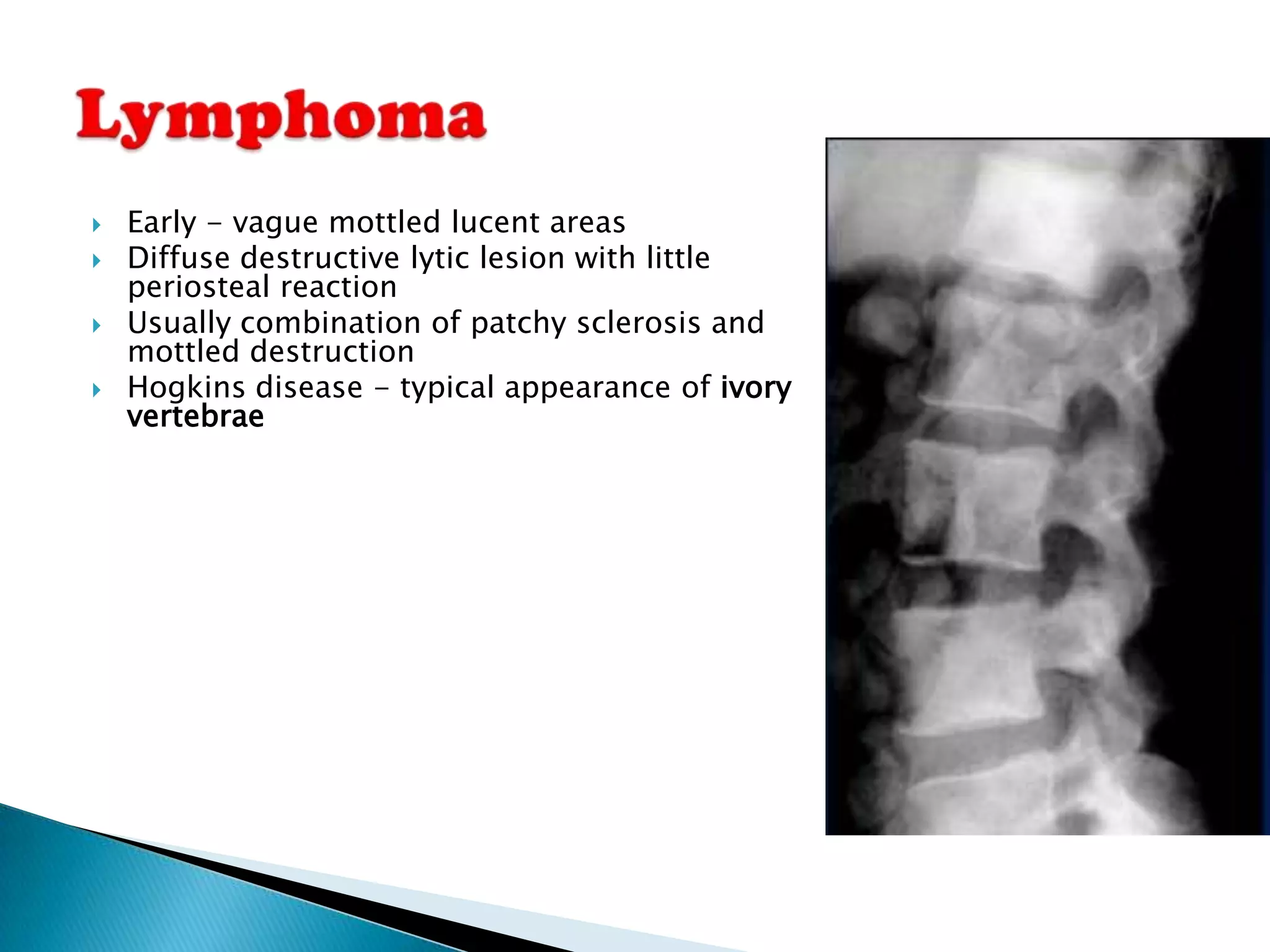    Early - vague mottled lucent areas
   Diffuse destructive lytic lesion with little
    periosteal reaction
   Usually combination of patchy sclerosis and
    mottled destruction
   Hogkins disease - typical appearance of ivory
    vertebrae
 